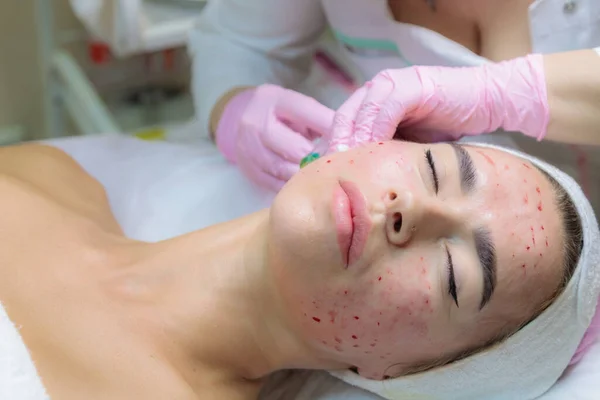 Il medico somministra iniezioni di plasma sanguigno in faccia a una ragazza. — Foto Stock
