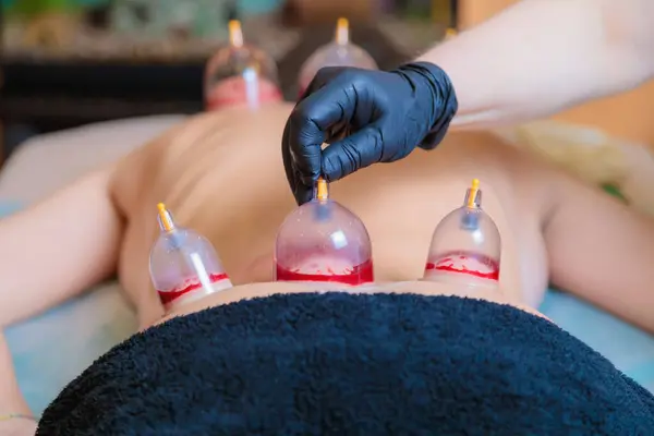 Bir hijama ustası genç bir kız için vakum kan emme prosedürü uygular.. — Stok fotoğraf