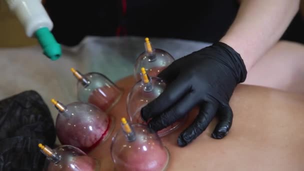 Un maestro hijama esegue una procedura di aspirazione del sangue sottovuoto per una giovane ragazza. — Video Stock