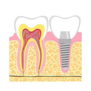 Diş ve diş implantı.