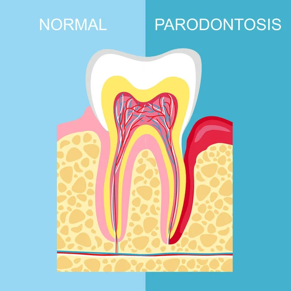 Impianto Dentale Illustrazione Vettoriale — Vettoriale Stock