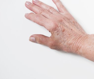 Yaşlı el yaralı parmak