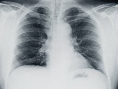 Lung X-ray clipart