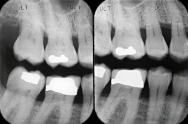 Left Periodontal X ray clipart