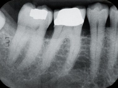 Periodontal sol alt köşesinde x-ışınları