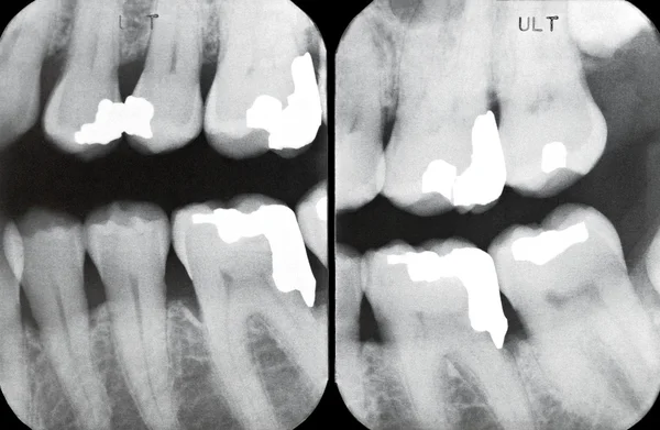 Radiografías periodontales derechas —  Fotos de Stock