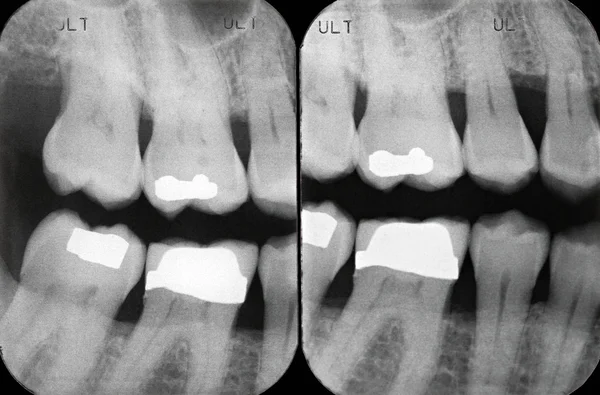 Radiografia periodontal esquerda — Fotografia de Stock