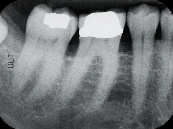 Radiografías periodontales inferiores izquierdas — Foto de Stock