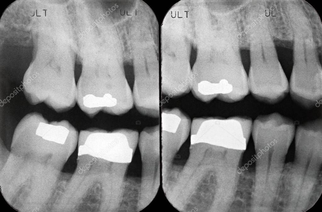 Left Periodontal X ray Stock Photo by ©Lawcain 67907643