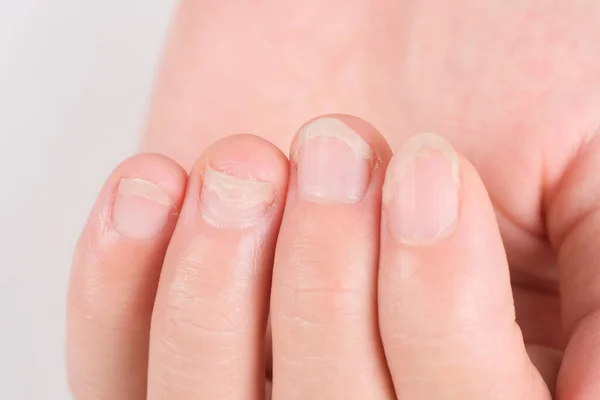 Onychomycosis Fungal Nail Infection Damaged Nails Gel Polish Onychosis Stok Resim