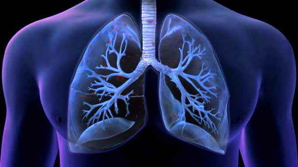 Μετάδοση Των Πνευμόνων Ρεαλιστικό Βίντεο Animation Του Σοβαρού Οξέος Αναπνευστικού — Αρχείο Βίντεο
