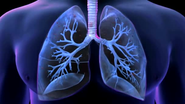 Longen Besmetting Realistische Beeldmateriaal Animatie Van Het Ernstige Acute Respiratoire — Stockvideo