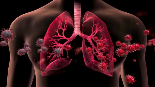 Los Pulmones Contagiados Animación Realista Imágenes Del Síndrome Respiratorio Agudo — Vídeos de Stock