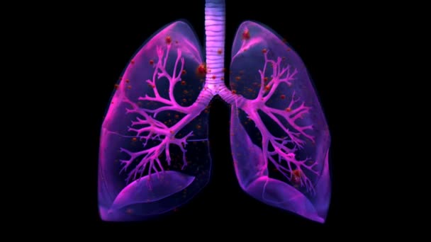 Contágio Pulmonar Animação Realista Síndrome Respiratória Aguda Grave Coronavírus Sars — Vídeo de Stock