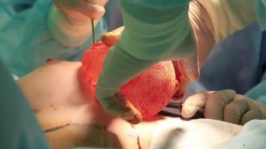 Göğüs implantı giriş