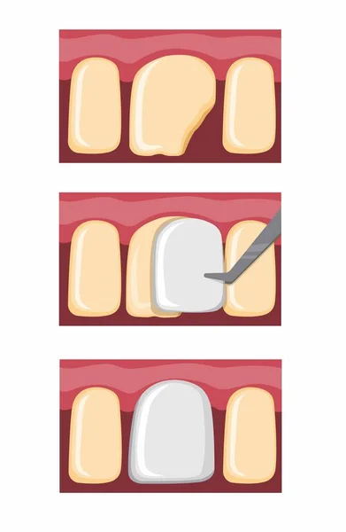 歯の修復歯の修復骨折した歯の漫画のフラットイラストベクトル白地に隔離された — ストックベクタ