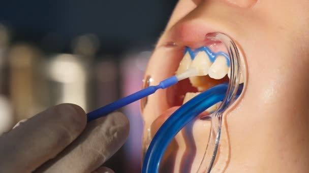 Відбілювання зубів крупним планом при повільному русі — стокове відео