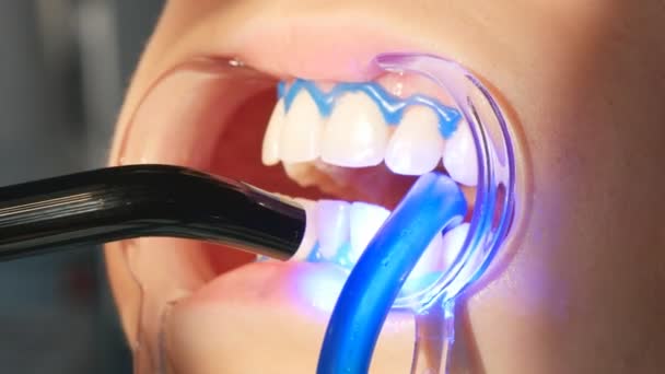 Dentist working with dental polymerization lamp in oral cavity. — Stock Video