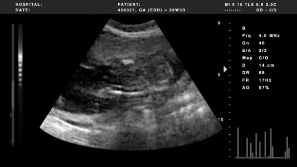 Grafiklerle birlikte ultrason — Stok video