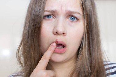 Virüs uçuğu dudaklı kız. Dudağında uçuk olan, parmağıyla dokunan genç bir kadın. Uçuk enfeksiyonu ve virüs tedavisi. Güzellik dermatoloji konsepti. İnsan papillomavirüsü, viral enfeksiyon.
