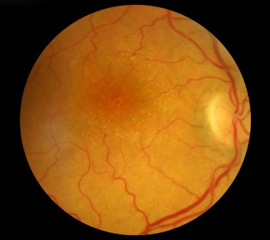 Medical Fundus photo of retinal pathology, hemmorhages, vein occ clipart
