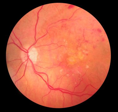 Medical Fundus photo of retinopathy hemmorhage clipart