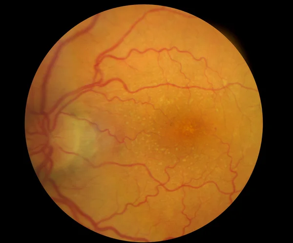 Medical Fundus photo of retinal pathology, hemmorhages, vein occ Stock Photo