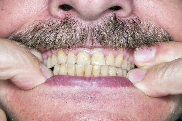 Dientes en la boca de un hombre — Foto de Stock