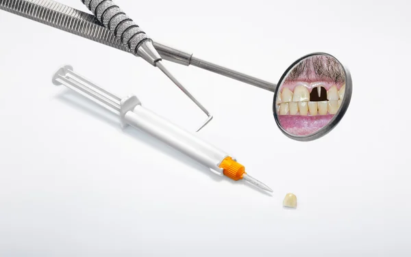 Siringa a due componenti e protesi dentale — Foto Stock