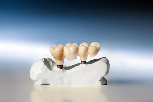 Plaster Model Bridge Made Two Tooth Implant Close Blue Gradient — Stock Photo, Image