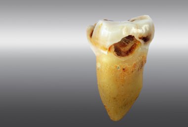 Yirmilik diş çürüğü tarafından etkilenen