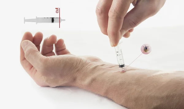 Odstranění klíštěte z kůže s injekční stříkačkou — Stock fotografie