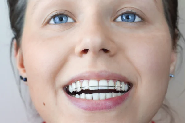 kadının ortodontik tedavi için kullanılan işlev cihazı