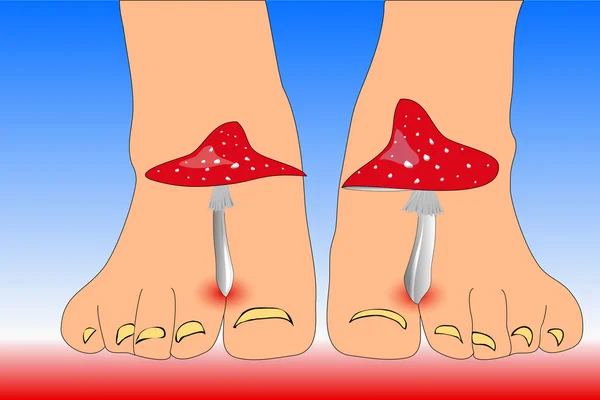 Amanita mushrooms between the toes feet imitating toes fungus — Stock Photo, Image