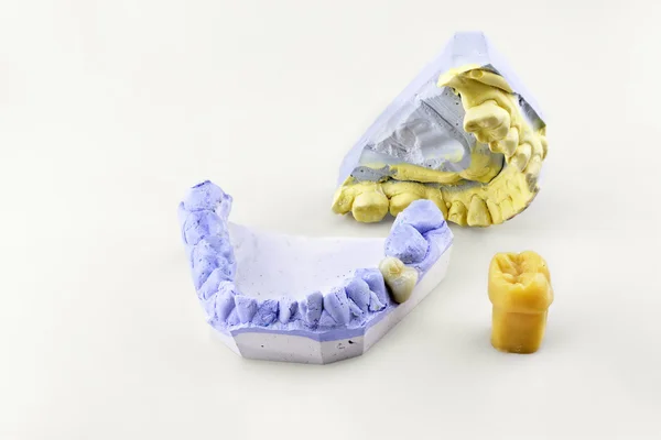 Dos moldes dentales y un modelo de diente — Foto de Stock