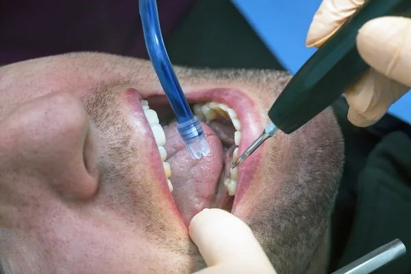 Dentista fazendo higiene dos dentes do paciente — Fotografia de Stock