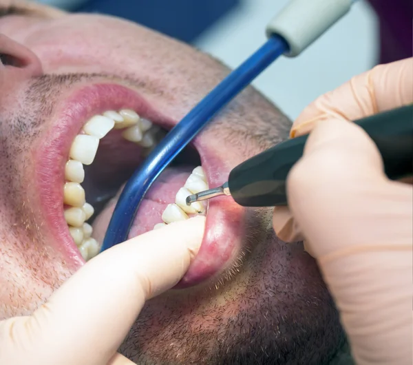 歯科医は患者さんの歯の衛生を作る — ストック写真