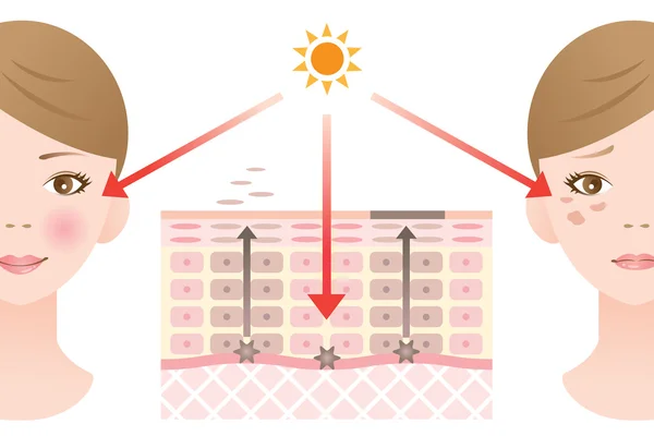 信息图皮肤插图。皮肤斑点机制 — 图库矢量图片