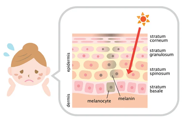 Infographic Skin illustratie. gelaats vlekken en huid mechaniek — Stockvector