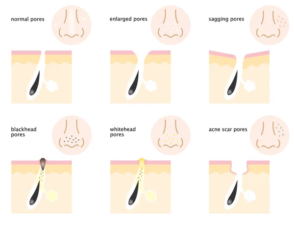 Diagrama de poros de la piel — Vector de stock