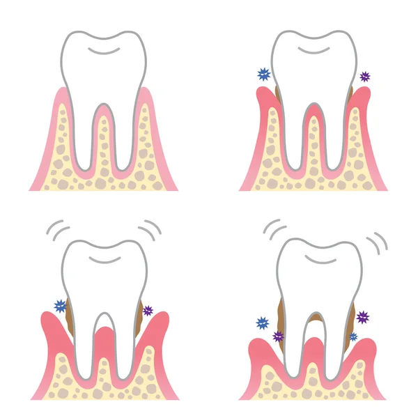 Síntomas de enfermedad periodontal — Vector de stock