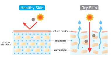 dry and healthy skin layer. stratum corneum and ceramides. illustration. beauty and skin care concept clipart