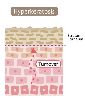diagram of skin cell turnover and thickening of the stratum corneum. Skin care and beauty concept clipart