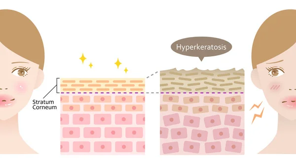 Hiperqueratosis Engrosamiento Queratina Epidermis Piel Sana Dañada Con Cara Femenina — Vector de stock