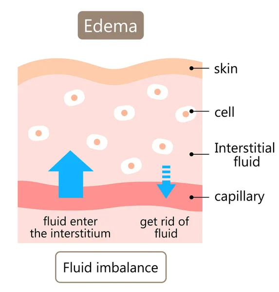 Edema 피부가 조직내에 액체때문에 일어난다 — 스톡 벡터