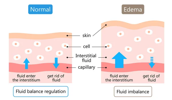 エデマと普通の皮膚の図 腫脹は体内の過剰な流体によって引き起こされます イラストの後 ヘルスケアの概念 — ストックベクタ