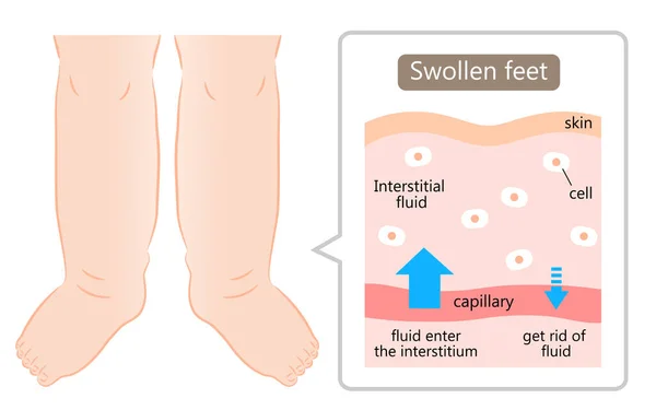 腫れた足のイラスト図です 腫脹は体内の過剰な流体によって引き起こされます ヘルスケアの概念 — ストックベクタ