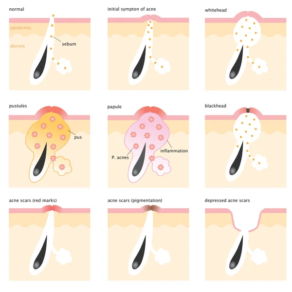 Acne formation process — Zdjęcie stockowe