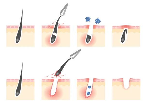 Tweezers hair removal skin troubles — Stock Photo, Image