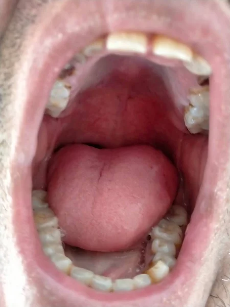Offener Mund Mit Kaputten Von Karies Betroffenen Zähnen — Stockfoto